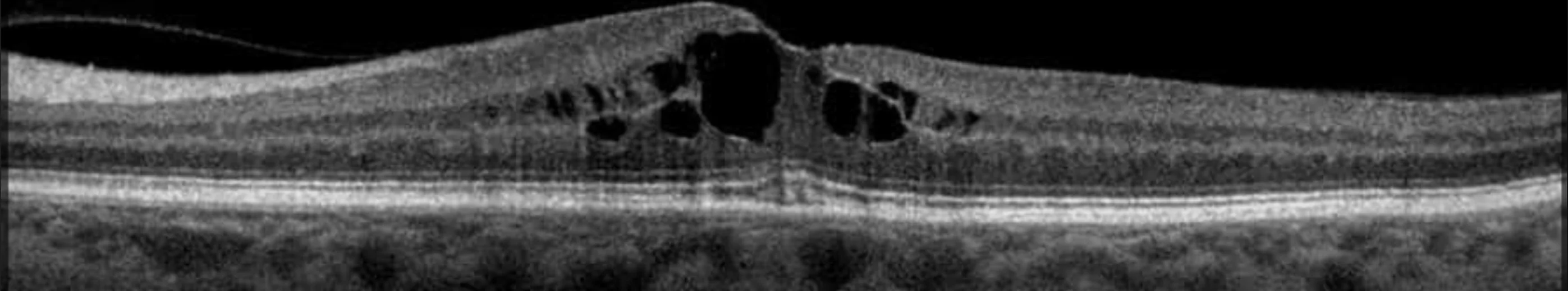 Tomografia de coerência óptica macular mostrando edema cistoide com cistos intra-retinianos característicos das doenças retinianas tratadas com injeção intravítrea